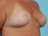 Patient # 74403 After Photo # 4